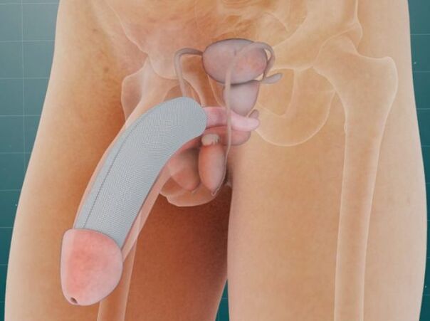 The penis after the insertion of a special implant under the skin