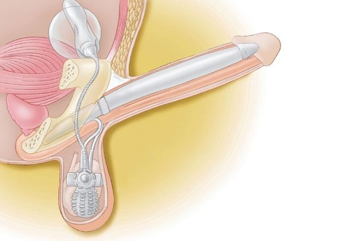 penis prosthesis for enlargement