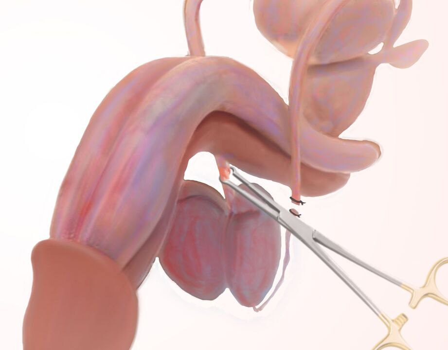 sphincterotomy for penis enlargement